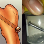 Screw operation