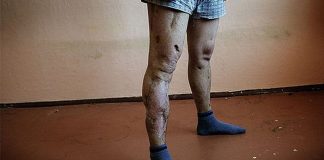 Flesh-eating Russian drug Krokodil that leaves addicts in a zombie-like state hits Australia