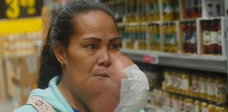 Brave woman undergoes lifesaving surgery for facial tumour