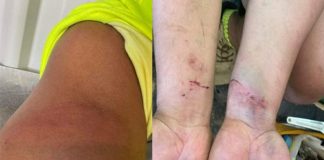 Investigation underway in Australia after bruised pics of Tongan Seasonal Worker emerge