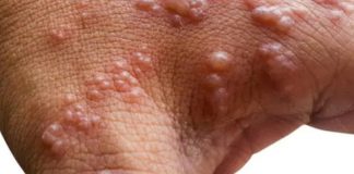 Monkeypox can be contained if we act now, WHO says