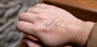 Four new cases of monkeypox in New Zealand