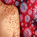 Monkeypox,Virus,Outbreak,As,A,Contagious,Infection,As,Blisters,And