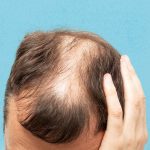 androgenic-alopecia-causes-and-risk-factors-subguide-1440×810